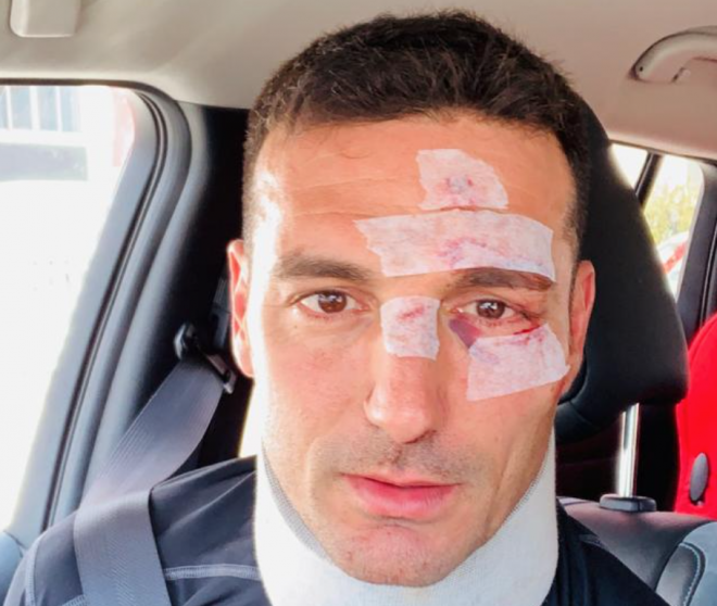 Lionel Scaloni enseña las heridas causadas por el accidente sufrido en Mallorca (Foto: Lionel Scaloni).