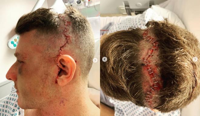Las heridas en la cabeza de Samuel Ward (Fotos: Instagram @samuel_ward13).
