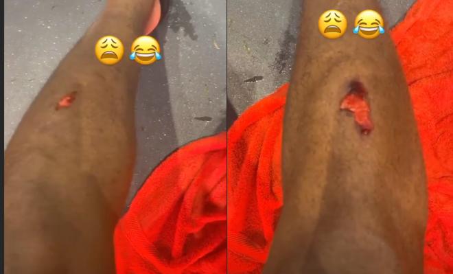 Las heridas de Martial tras chocar con el palo durante el Manchester United-City (Fotos: Instagram)