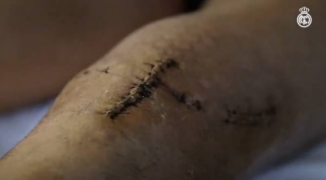 Cicatriz en la rodilla de Marco Asensio.