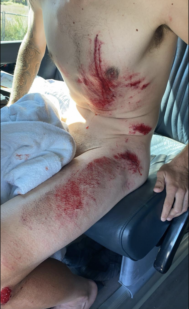 El ciclista español Ángel Madrazo muestras sus heridas tras una caída en la Coppi e Bartali.