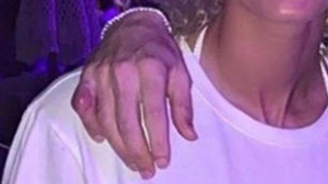 El supuesto dedo meñique de Benzema.