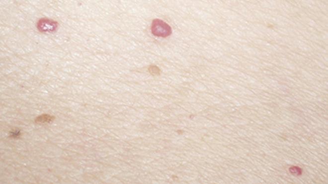 Los lunares rojos realmente son vasos dilatados en la superficie de la piel que sobresalen. (Sociedad Española de Médicos Generales y de Familia)