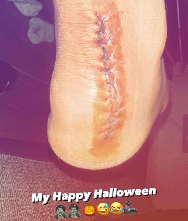 Cicatriz del pie de Marc Bartra (Foto: @MarcBartra)