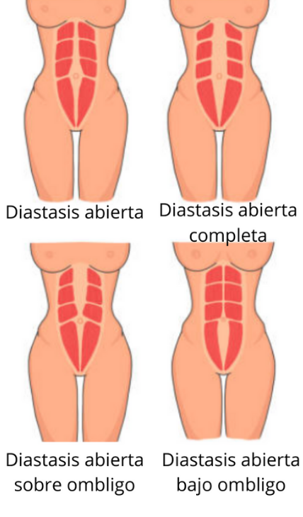 Tipos de diástasis abdominal. (midiastasisabdominal.com)