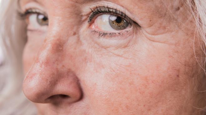 Las manchas de la cara dependen mucho de la edad, el fototipo y la exposición al sol.