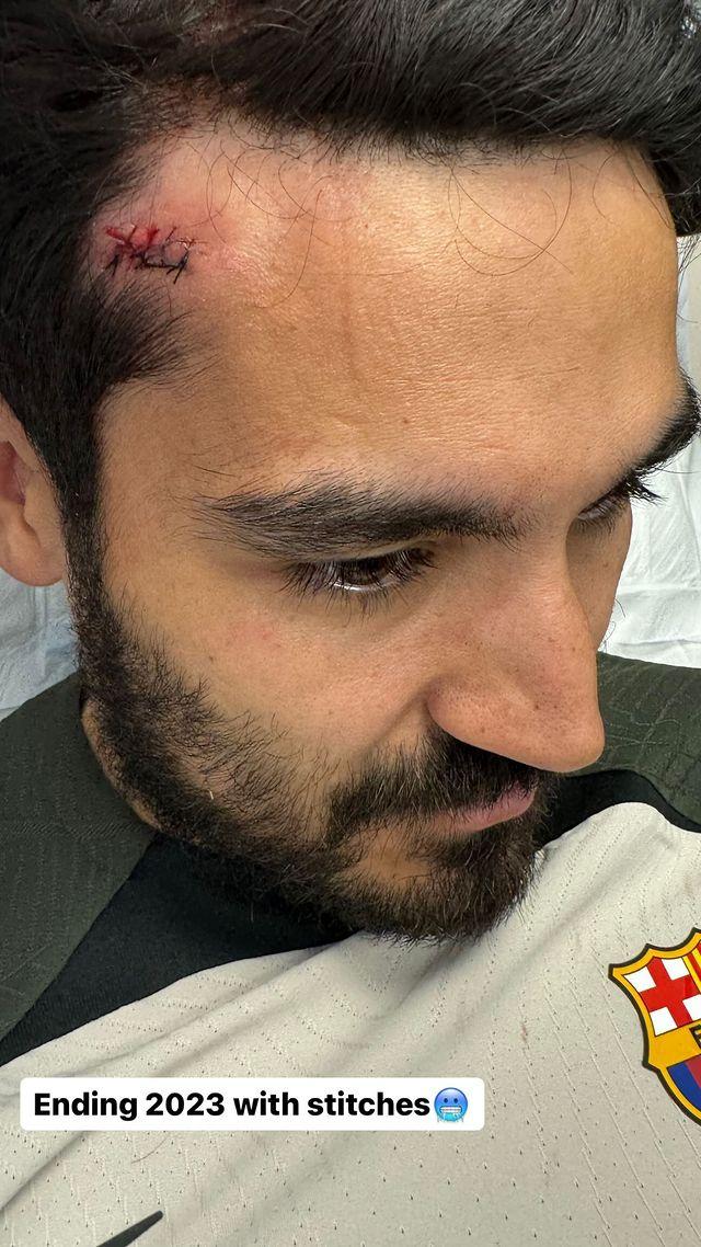La herida de Gündogan después de un entrenamiento con el Barça (Foto: @saraguendogan).