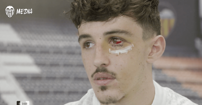 Diego López reaparece con un derrame en el ojo