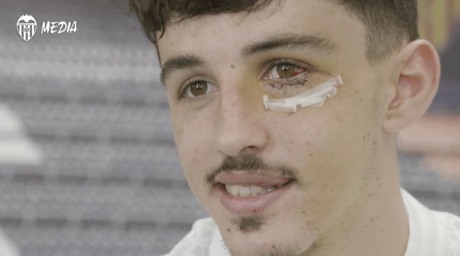 Diego López reaparece con un derrame en el ojo