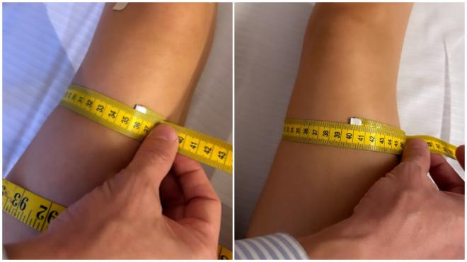 La diferencia de tamaño entre las piernas de Marta Díaz.