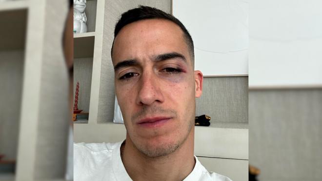 Lucas Vázquez muestra cómo ha quedado su rostro después del codazo de Ocampos