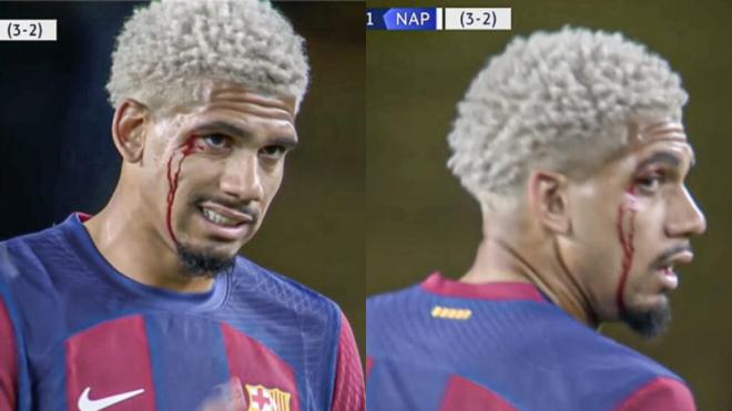 La herida de Ronald Araujo en el Barça - Nápoles (Captura de la retransmisión de Movistar +)