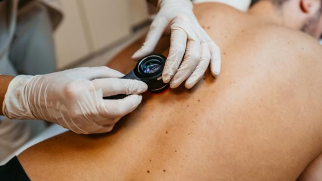 Dermatólogo observando la posible presencia de un melanoma en la piel de un paciente (Asociación