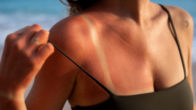 Mujer con una quemadura en los hombros por el sol (Foto: Freepik)