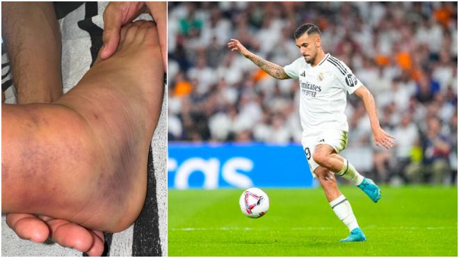 Dani Ceballos muestra su pie.