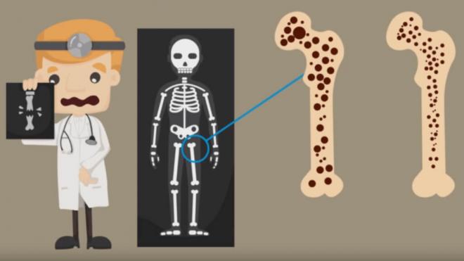 Ilustración mediante dibujos de la definición de osteoporosis (Foto: Fundación Española de Reumatología)