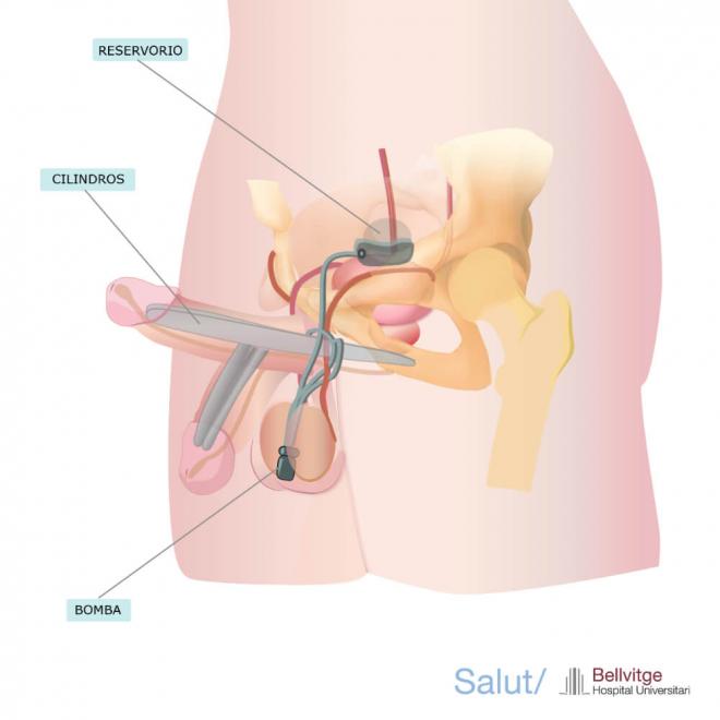 Implante de pene hinchable de tres piezas (Foto: Hospital Universitario de Bellvitge)