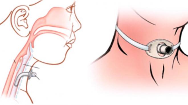 Representación de una persona con una traqueostomía (Foto: Hospital del Mar)