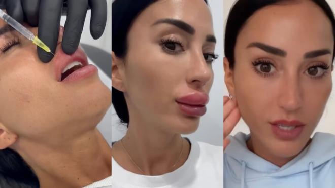 Antes y después de Aurah Ruiz tras quitarse los labios (Foto: @aurah.ruiz)