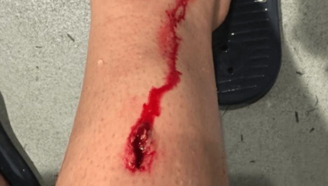 Herida de Beñat Prados en su pierna (Foto: Instagram).