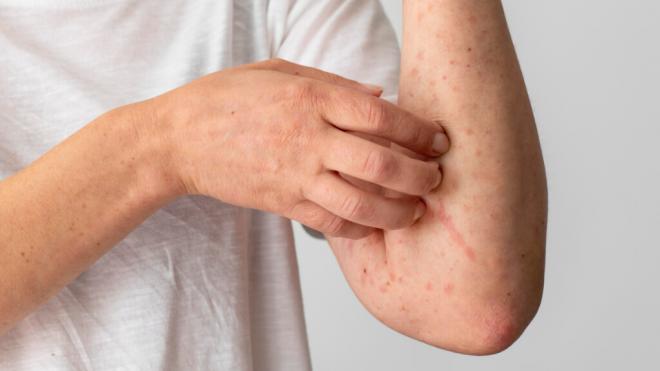 Erupción cutánea en el brazo de una persona (Foto: Freepik)