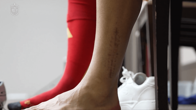 La cicatriz de Isco. (Foto: SeFutbol)