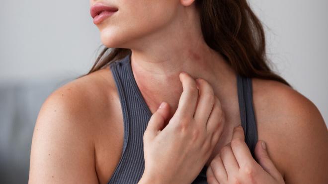 Mujer rascándose un sarpullido del cuello (Foto: Freepik)