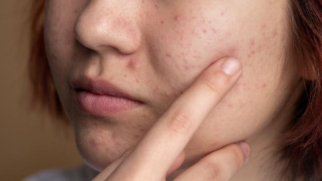 Mujer mostrando las marcas de acné en su cara (Foto: Freepik)
