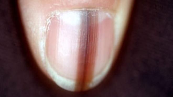 Uña con una línea marrón (Foto: Revista Médica de Chile)
