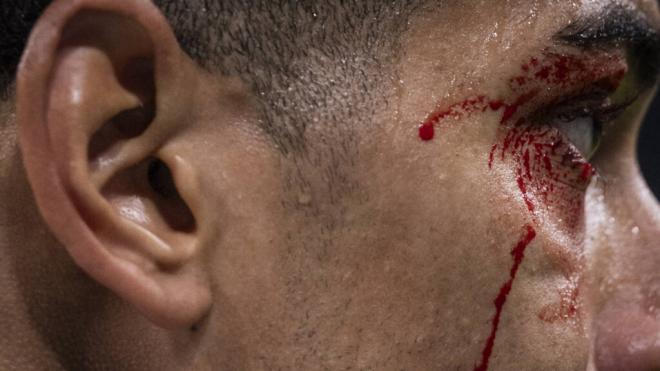 Detalle de la ceja de Jude Bellingham tras el golpe con Borja Iglesias en el Real Madrid-Celta (Cor