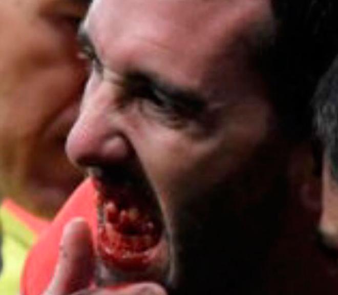 Godín perdió tres dientes contra el Valencia (Foto: EFE).