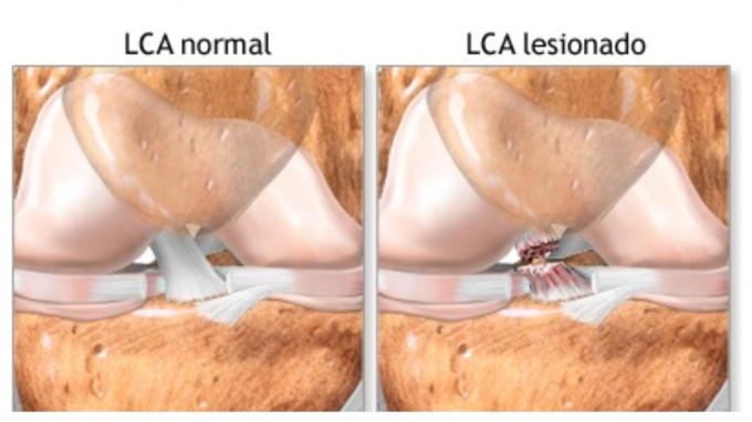 Rotura del ligamento cruzado anterior.
