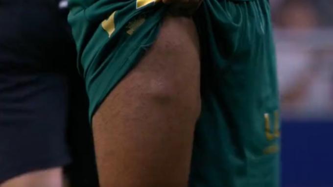 Lipomas en el muslo derecho de Fali durante el partido Atleti-Cádiz. (@DAZN_ES)